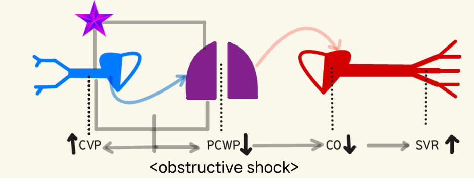 obstructive shock