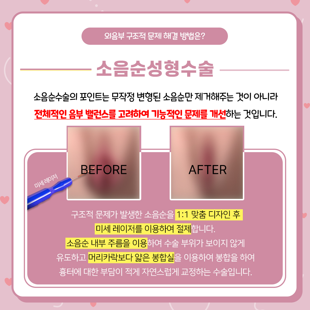 선릉산부인과 만성질염 소음순 때문일까?