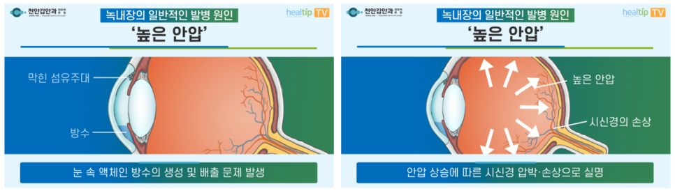증상이 없고 정상 안압에도 위험한 이유는 천안안과 추천, 3대 실명질환 녹내장!