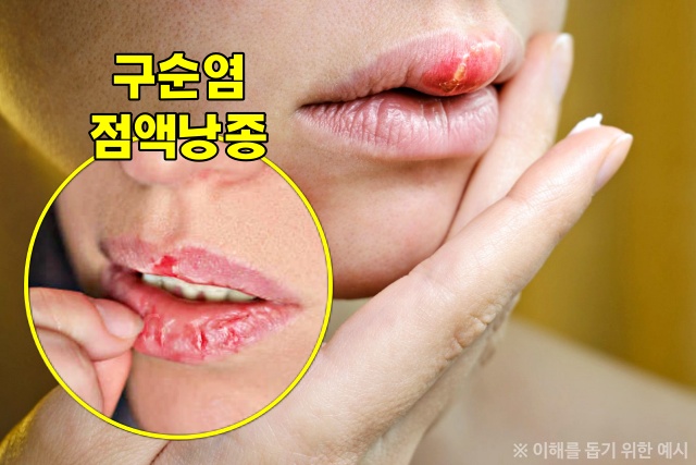입술 각질 원인, 입술 건조증, 입술 갈라짐,건강 팁줌 매일꿀정보