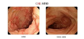 대장내시경 당일식사 주의사항 피해야 하는 음식_3