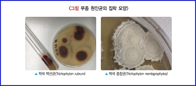 무좀 원인균