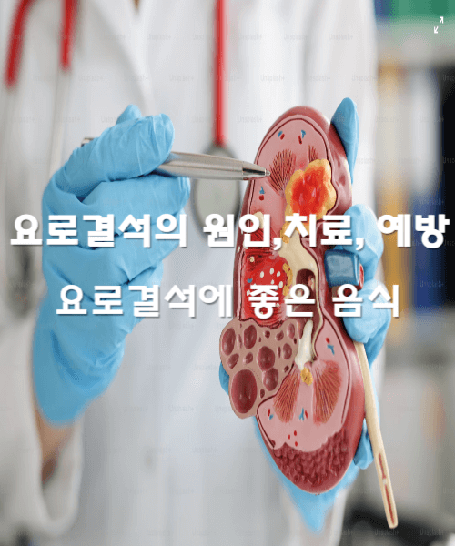 요로결석의 원인 치료 예방 그리고 좋은 음식