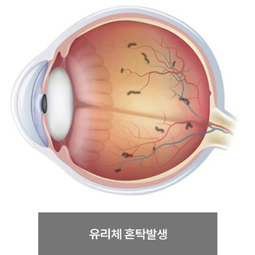 유리체 혼탁발생