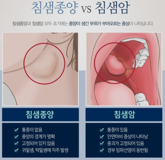 침샘종양과의구분