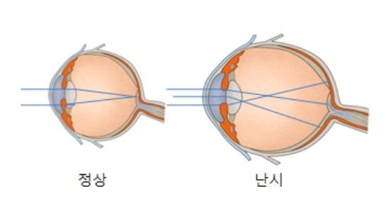 난시란?