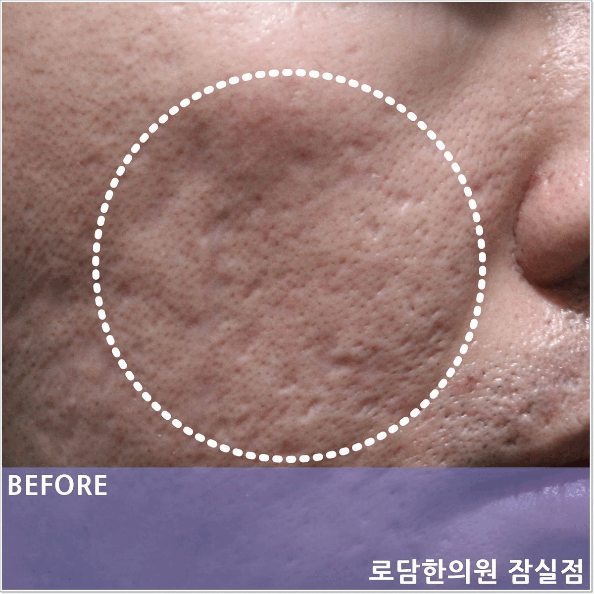  여드름 흉터 치료 과정 새살침 코라테라피로 알아보세요