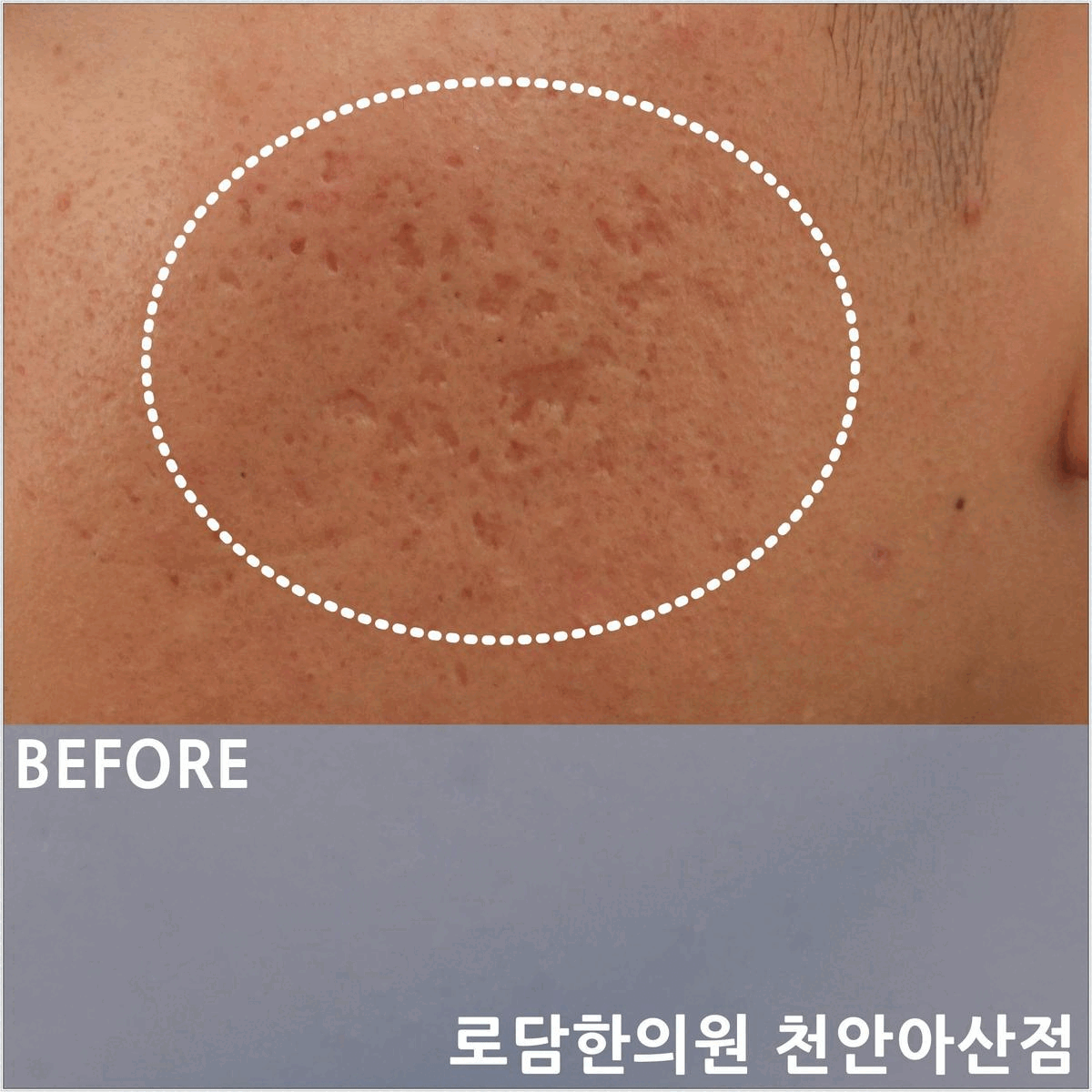  여드름흉터제거 치료 과정 새살침 코라테라피