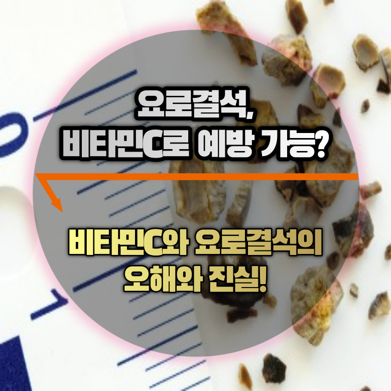 요로결석&#44; 비타민C로 예방할 수 있을까?