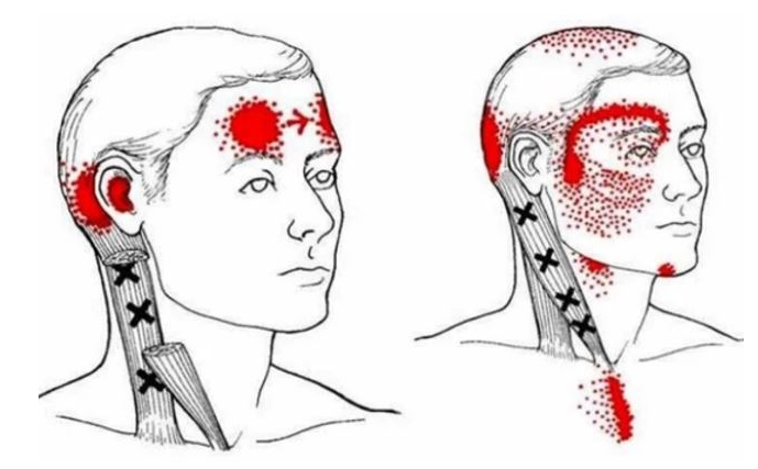 귀가 찌릿 아파요, 귀 뒤쪽 통증, 귀 신경통 : 대이개신경과 흉쇄유돌근