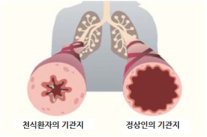  천식 원인 증상 치료방법 총정리