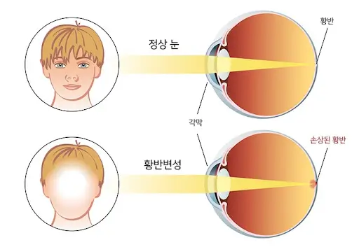  [눈 건강] 노화성 황반 변성 예방 건강 식품: 원인별 추천 및 섭취법