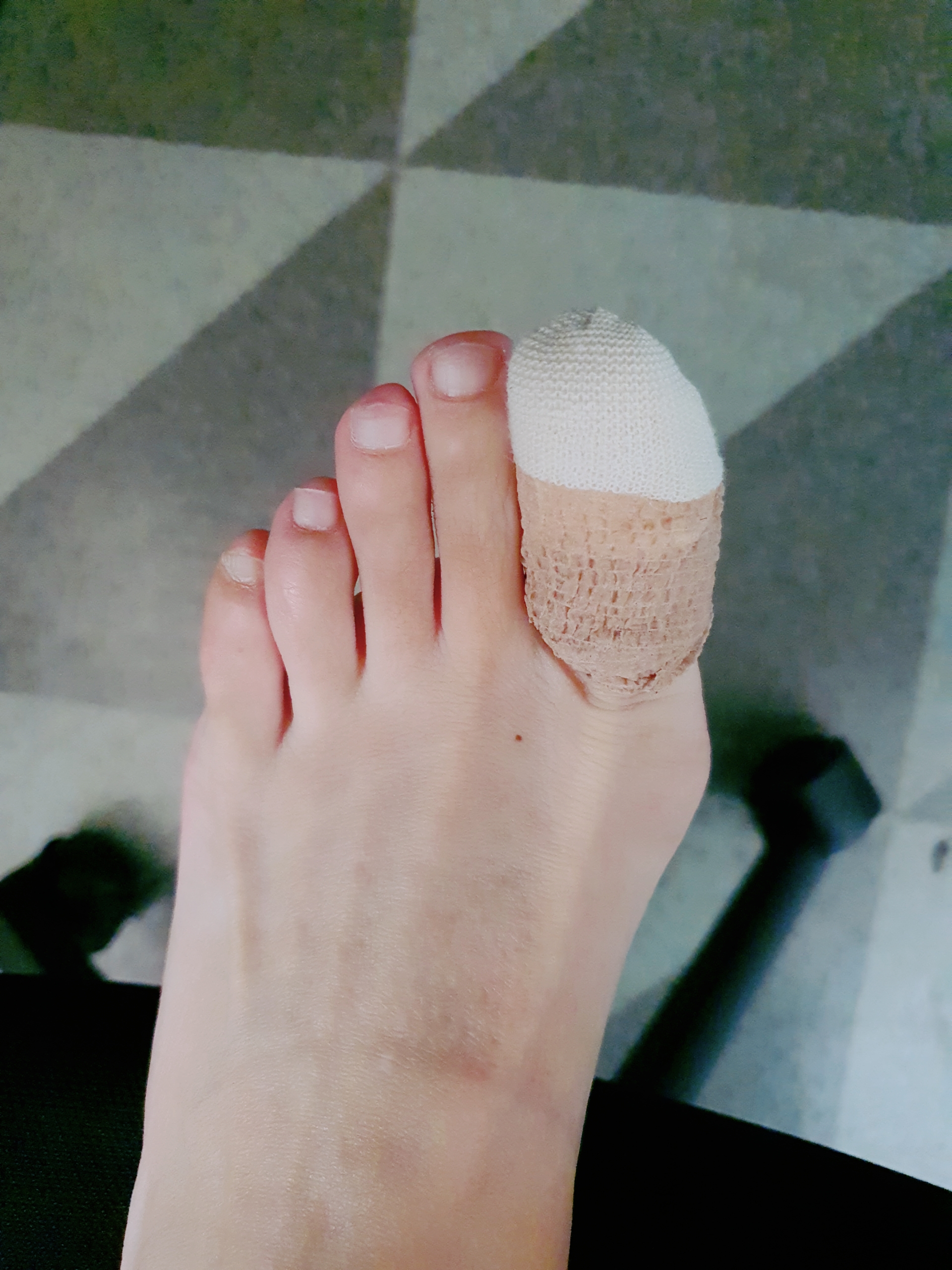  내성발톱 치료하기