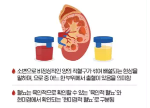 혈뇨-사진3