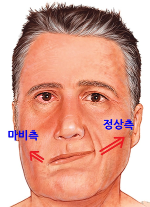 돌발성난청, 거대세포바이러스, 풍진 유행성이하선염 홍역 대상포진 바이러스 바이러스성 미로염(내이염) 원인, 증상, 검사, 치료 / 6