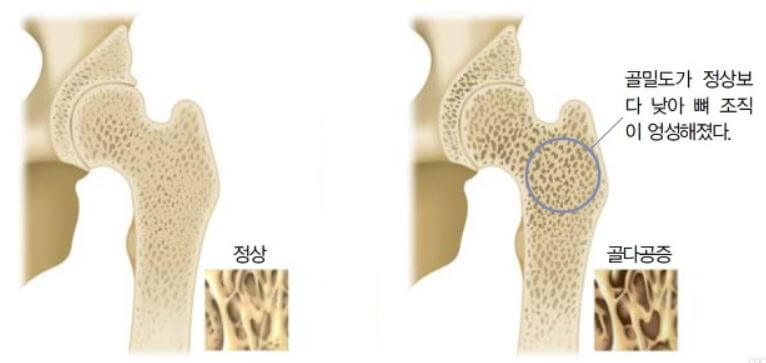 골다공증 증상