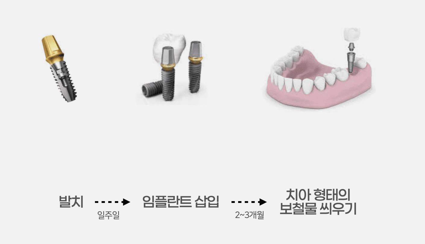 임플란트 대략적인 치료 과정