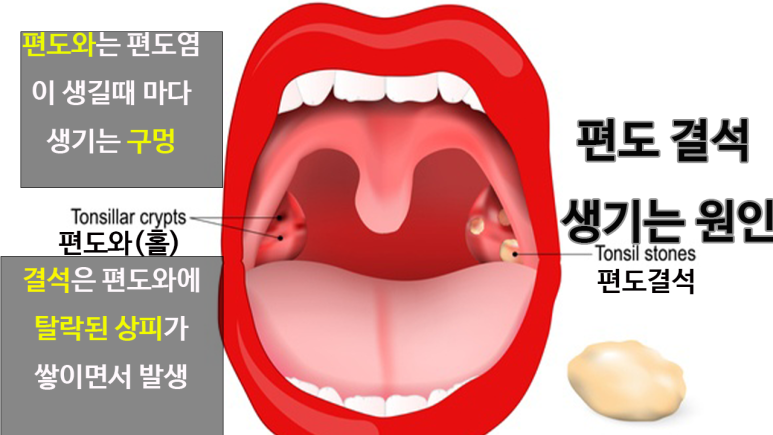 편도 결석 수술을 고려할 점은? 부산 편도결석 제거방법과