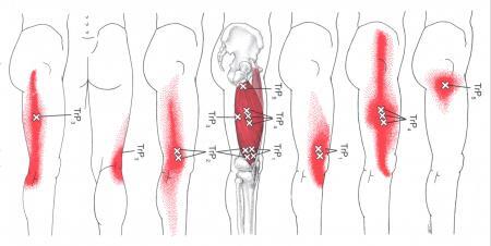 허벅지의 trigger point_외측광근