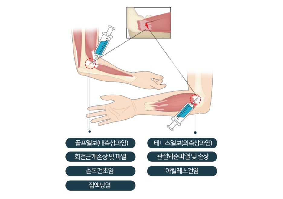[프로필 치료/프로필러 주사] 프롤린 주사 부작용은? 3