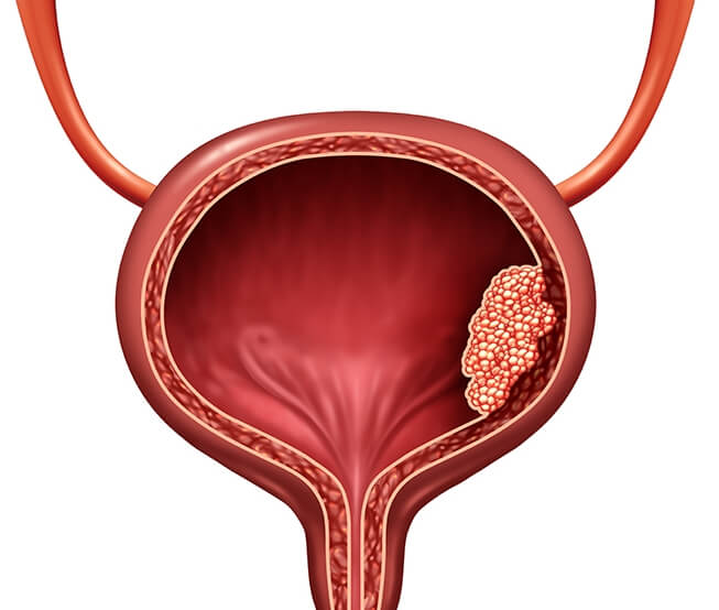  아파서 데구르르...방광암의 원인과 증상 치료방법은 무엇일까요?