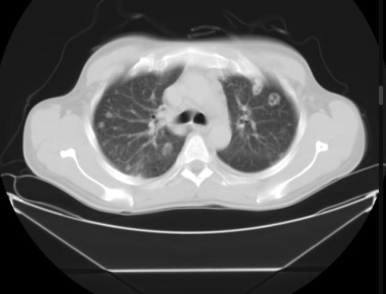 septic emboli의 흉부 CT 촬영