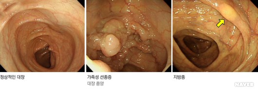  대장내시경 주의사항/결과