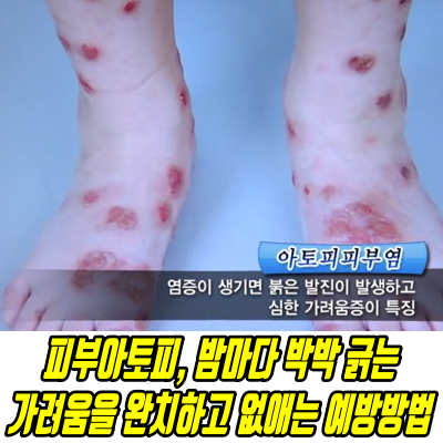  아토피가려움, 밤마다 간지러움 아토피 가려움증 완화 해소방법