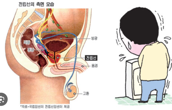 전립선암, 조기 발견의 중요성과 적절한 치료