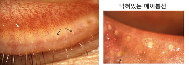 눈꺼풀 기름샘 위치(왼쪽)와 굳은 기름으로 막힌 기름샘 모습/사진=누네안과병원 제공