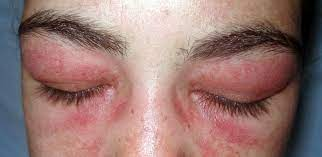 Heliotrope rash