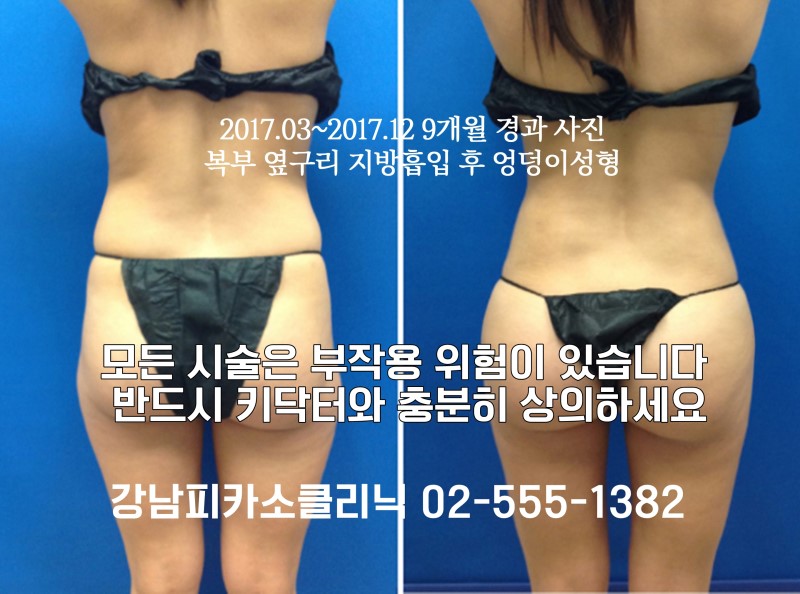  옆골반 볼륨 꺼진 힙딥성형수술 바디필러&힙딥지방이식 효과 유지기간 정보