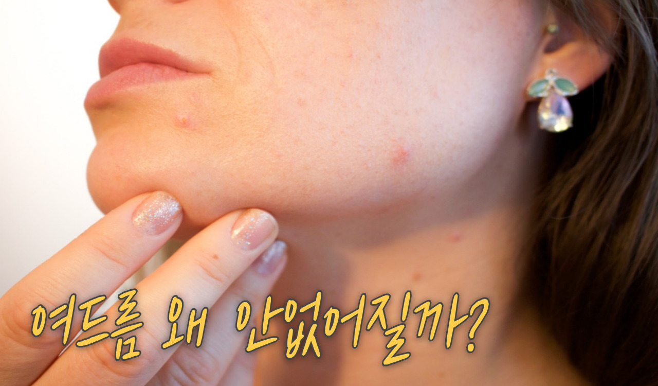 여드름 문제