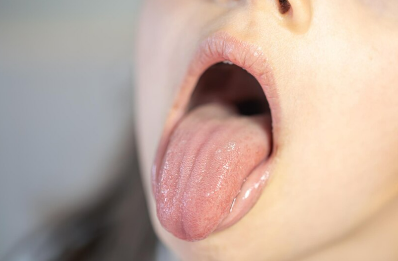 베체트 병&#44; 베체트 병 증상&#44; 베체트 병 원인&#44; 베쳍 병 치료