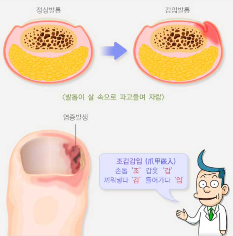 조갑감입 발톱의 개념