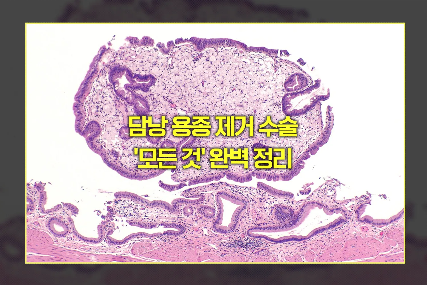 담낭 용종 제거 수술