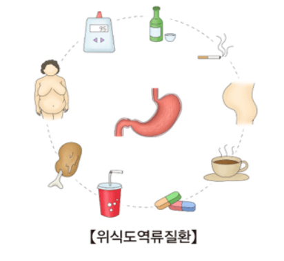 역류성식도염