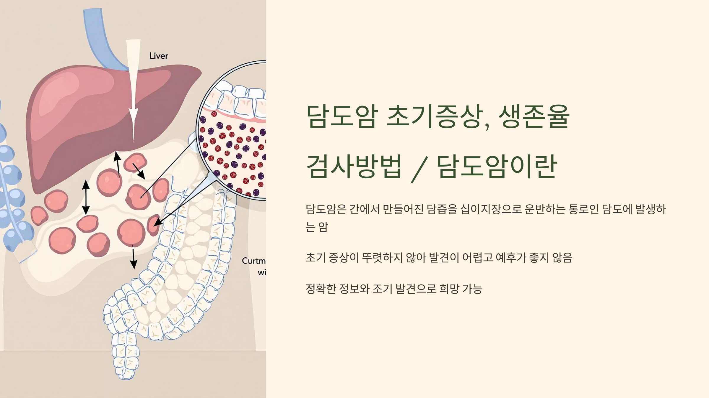 담도암 초기증상, 생존율, 검사방법 / 담도암이란