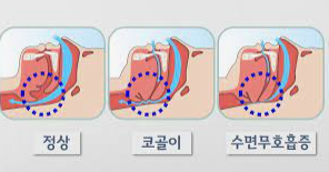 코골이 치료