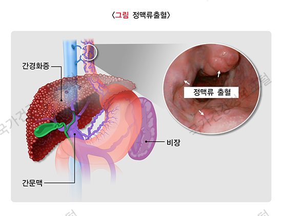 정맥류 출혈