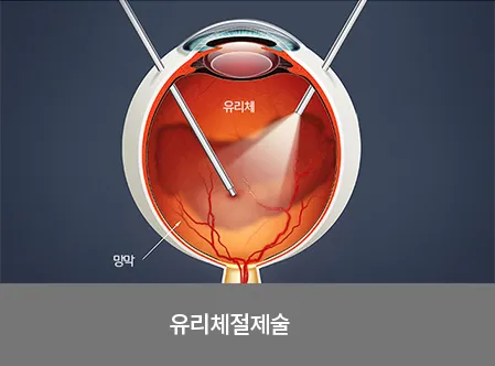 비문증 치료방법