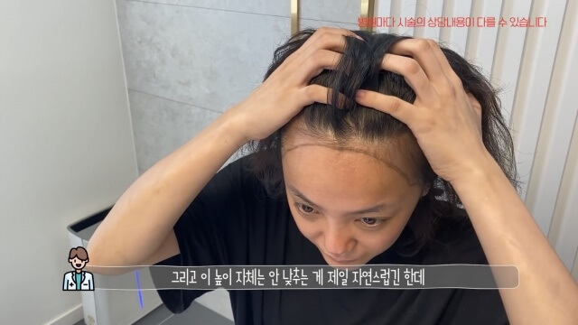  고은아 모발이식 성공