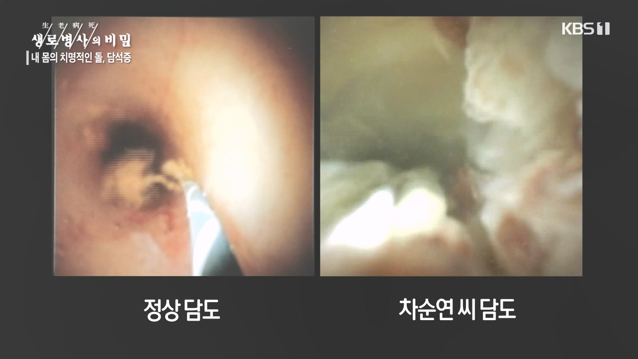 생로병사의 비밀.E886.231019p-NEXT.mp4_20231019_203446.492.jpg