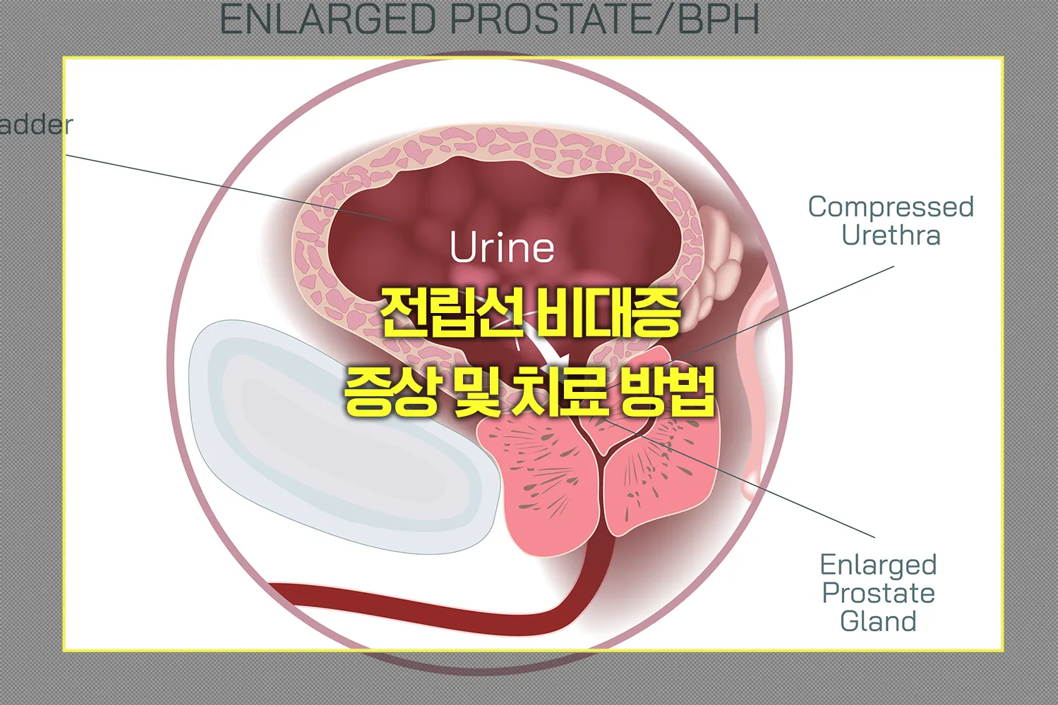 전립선 비대증 증상 및 치료 방법