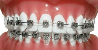 치아교정장치 메탈