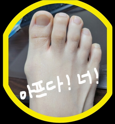 무지외반증 이란? 1