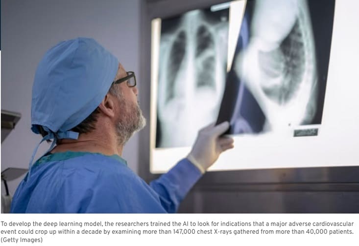 인공지능 의료기술...전문의 뛰어넘는다 AI Could Predict Heart Attack or Stroke with One X-Ray