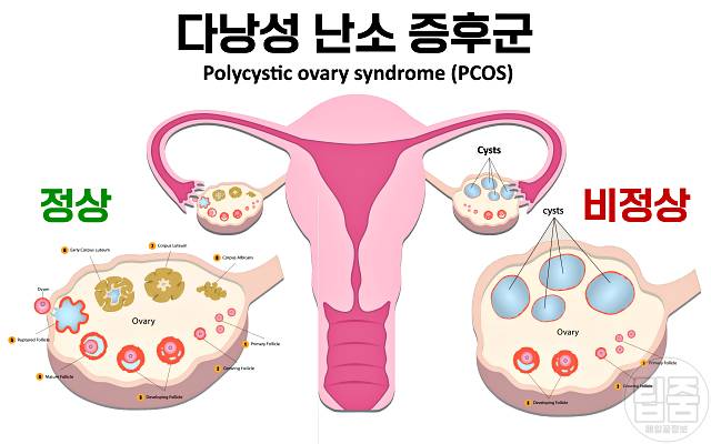 다낭성난소증후군 증상 자가진단 여자 살찌는병