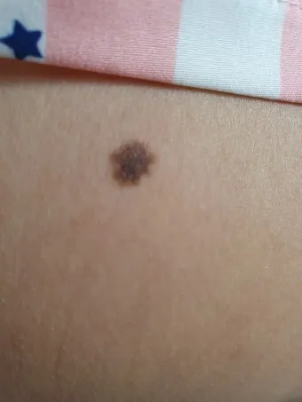 몸에 점이 계속 생기는 이유 원인부터 예방법까지 한눈에_9