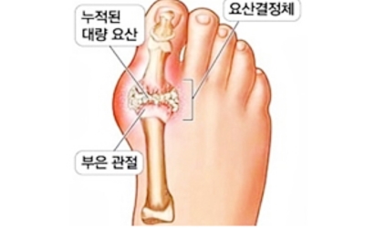 통풍이미지